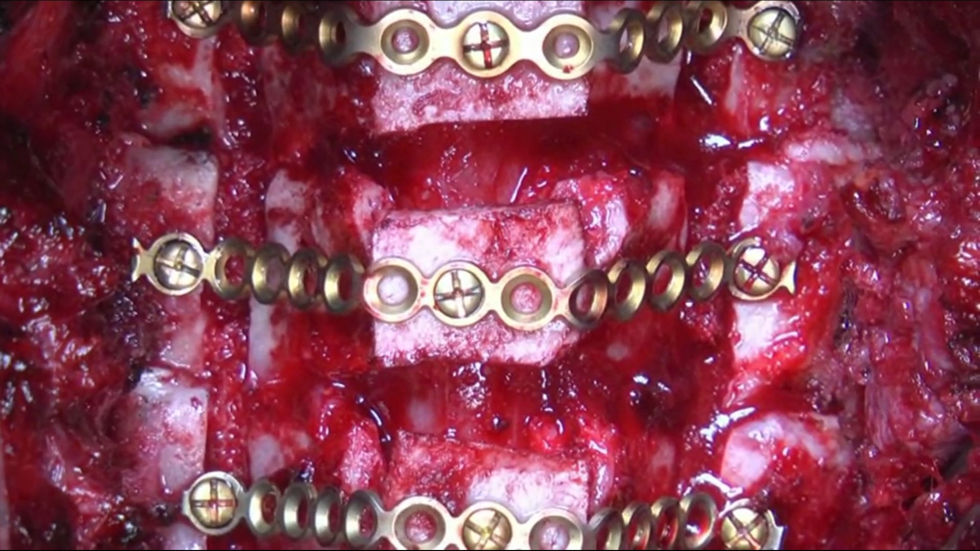 Double door (French Door) cervical laminoplasty