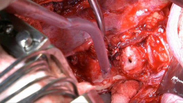 Surgical management of thoracic disc herniation