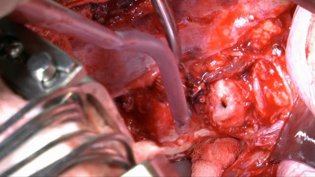 Surgical management of thoracic disc ...