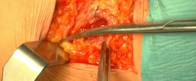 Transthoracic lateral retropleural minimally invasive microdiscectomy .......