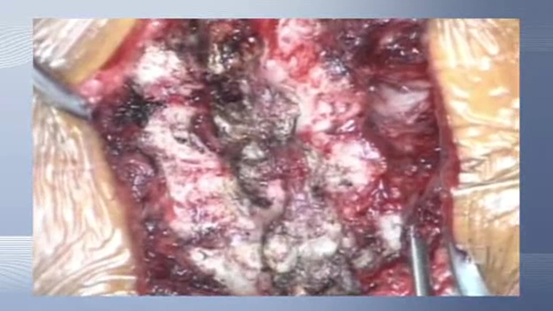 Cervical laminoplasty