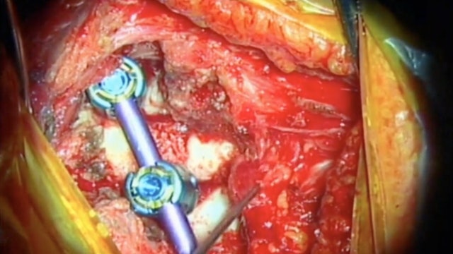 Trailer Computer navigation guided excision of cervical osteoblastoma