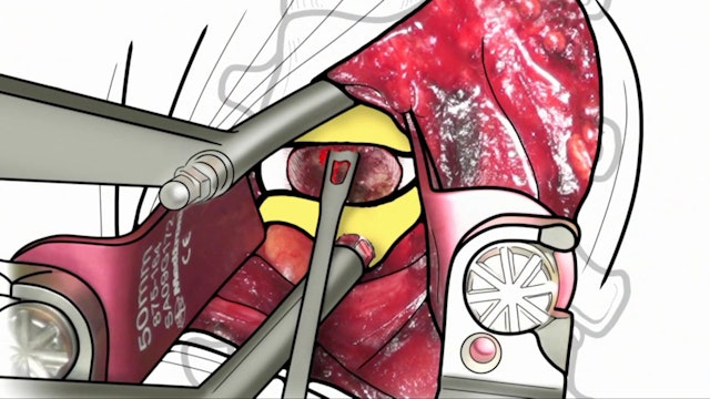 Single level anterior cervical discectomy and interbody fusion