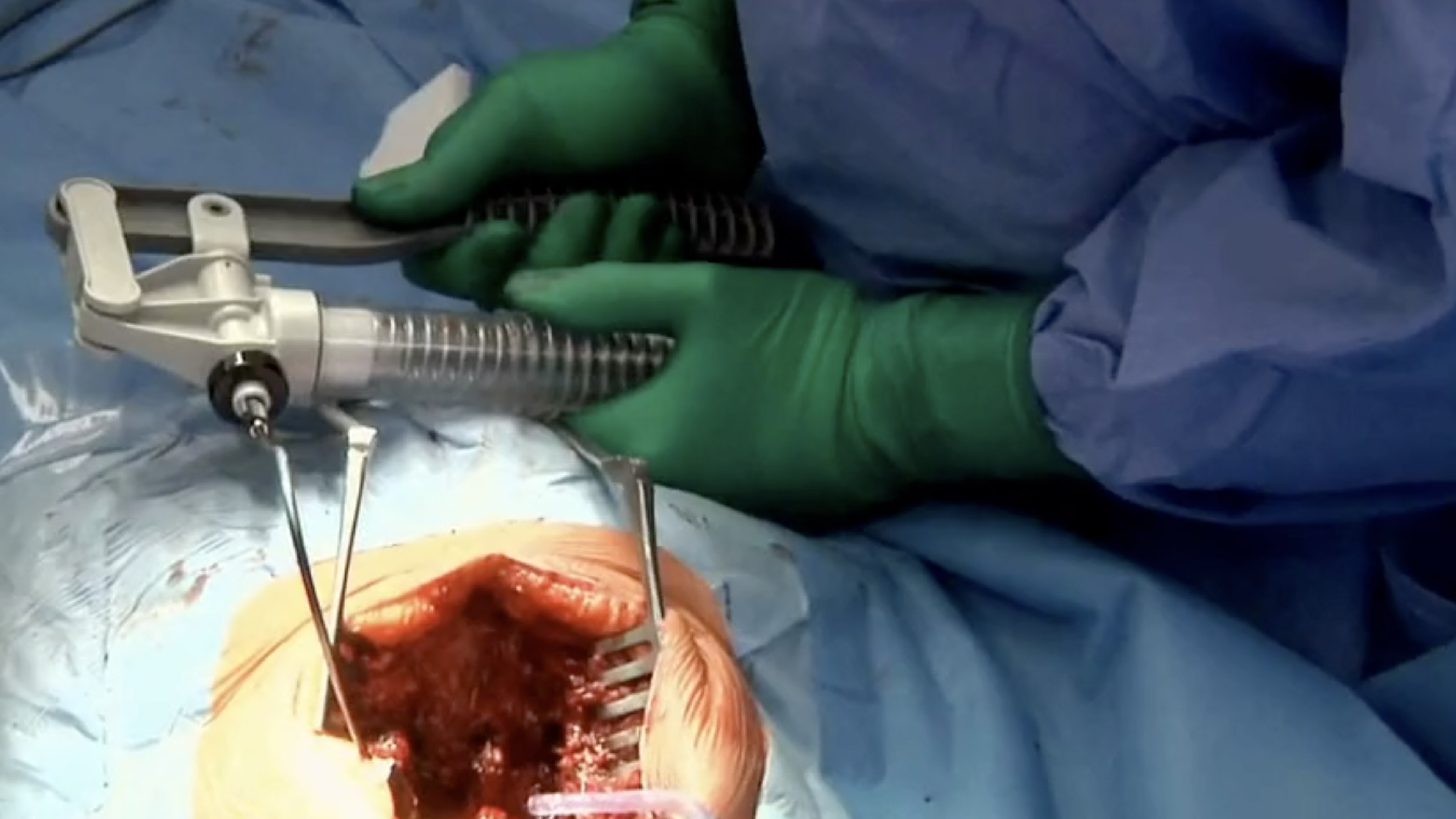 Trailer Treatment of de novo scoliosis with combined posterior and anterior....