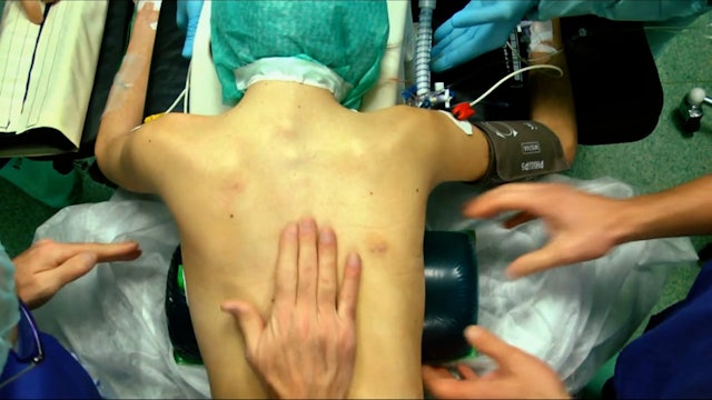 Trailer Adolescent idiopathic scoliosis surgery with patient-specific screw...