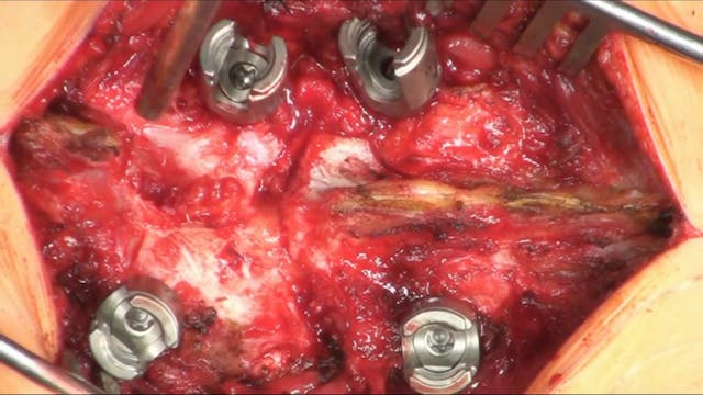 Transpedicular hemivertebra resection...