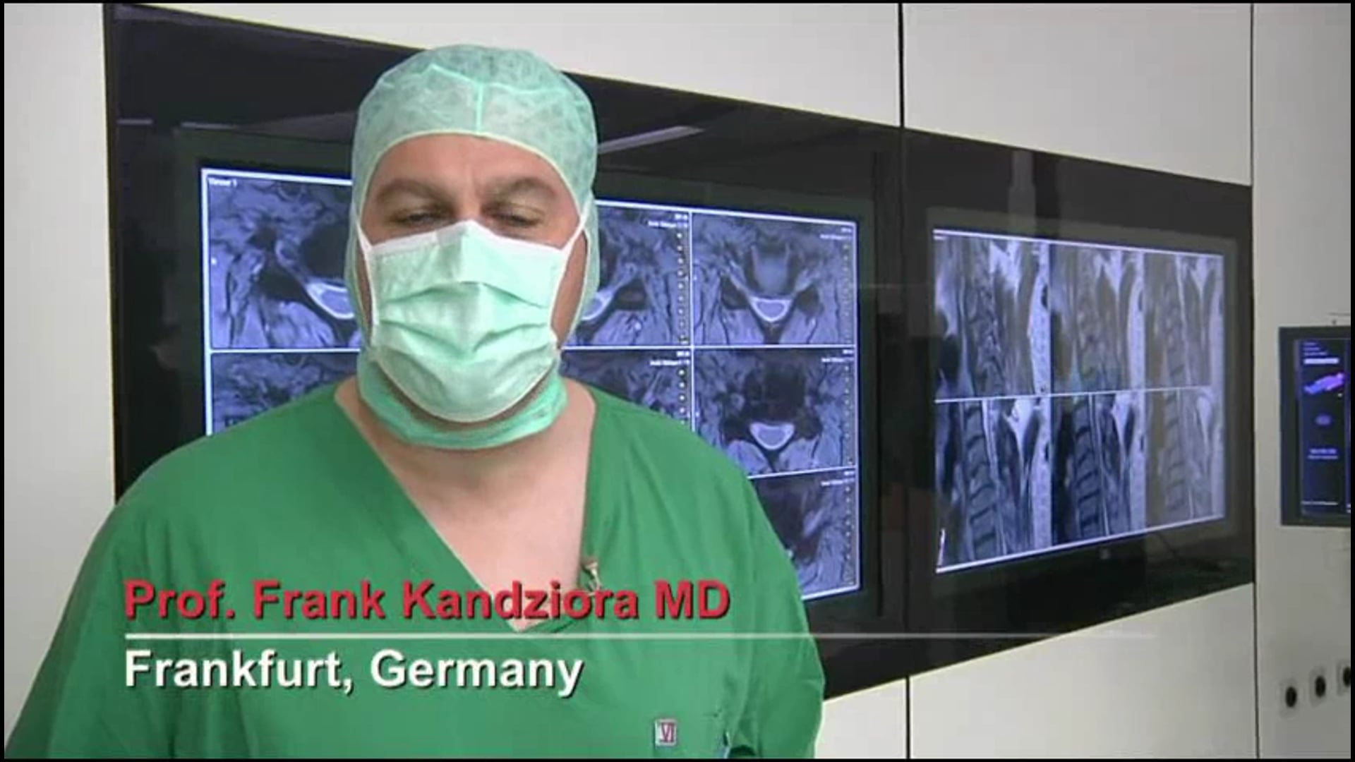 Anterior decompression and fusion for cervical spinal canal stenosis