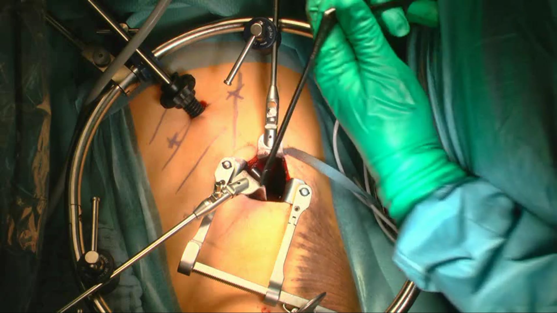 Incomplete cranial burst fracture of L1 treated by mini-open ......