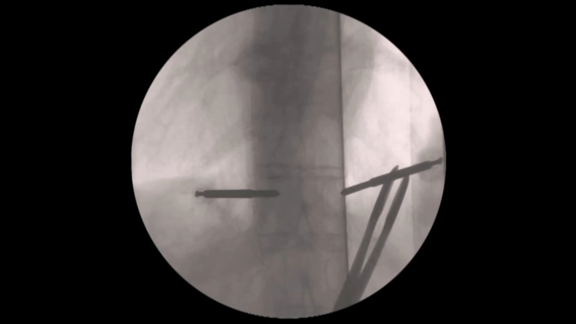 Trailer Percutaneous stabilization of a T9/10 fracture in a patient with anky...