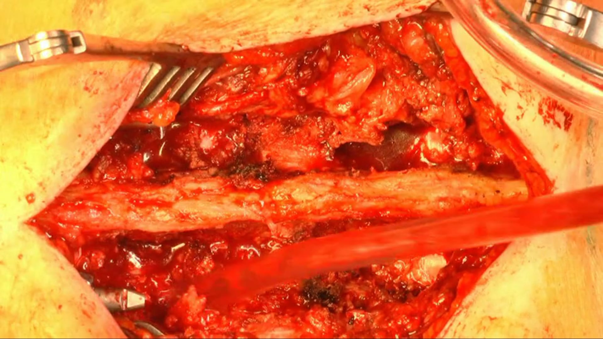 Posterior long segment stabilization of an adjacent insufficiency fracture