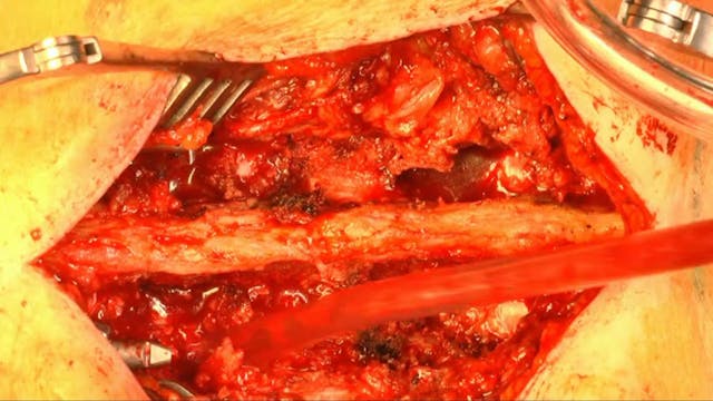 Posterior long segment stabilization ...