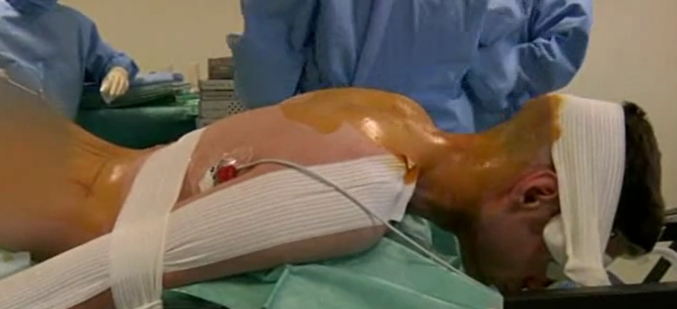 Cervical osteoblastoma resection and posterior fusion