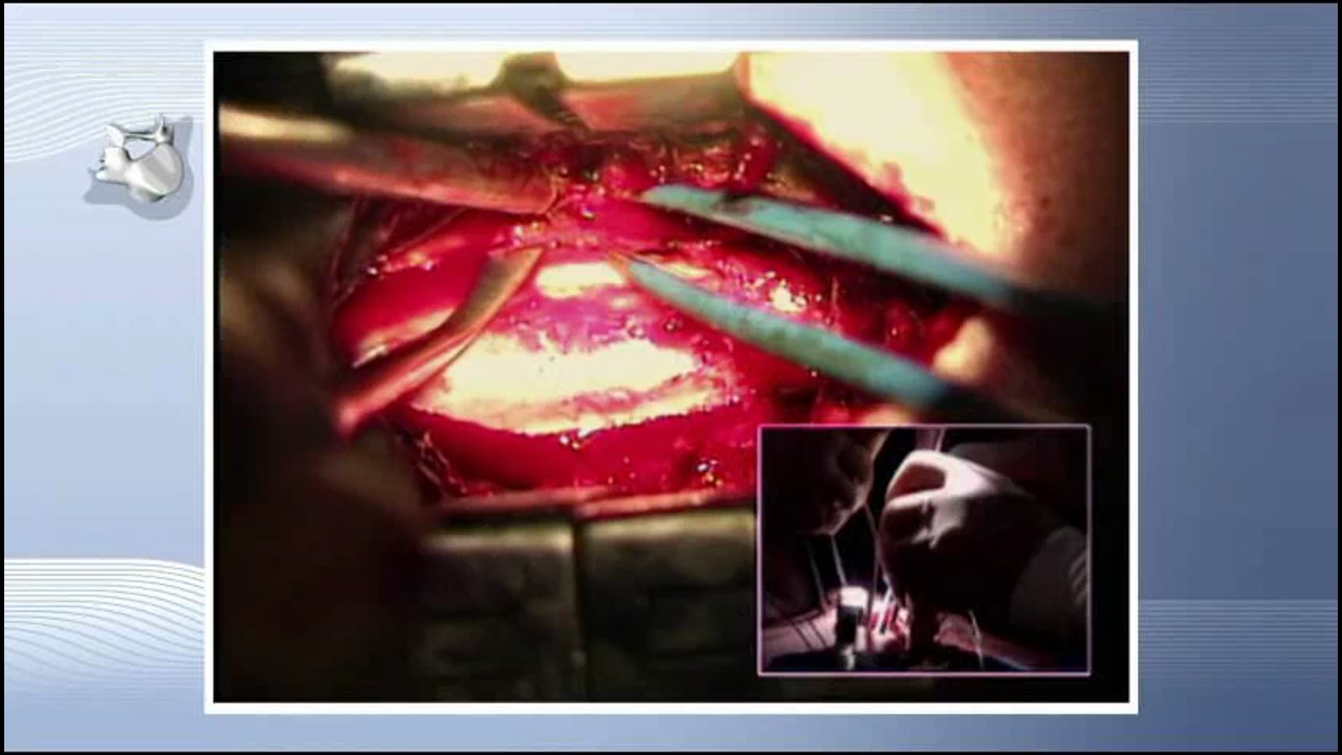 Minimal-invasive  stabilization and circumferential spinal cord decompression...