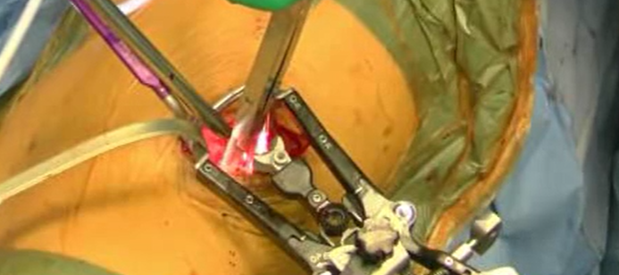 Sagittal alignment correction and reconstruction of lumbar posttraumatic kyphosi