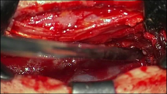 Resection of filum terminale ependymoma