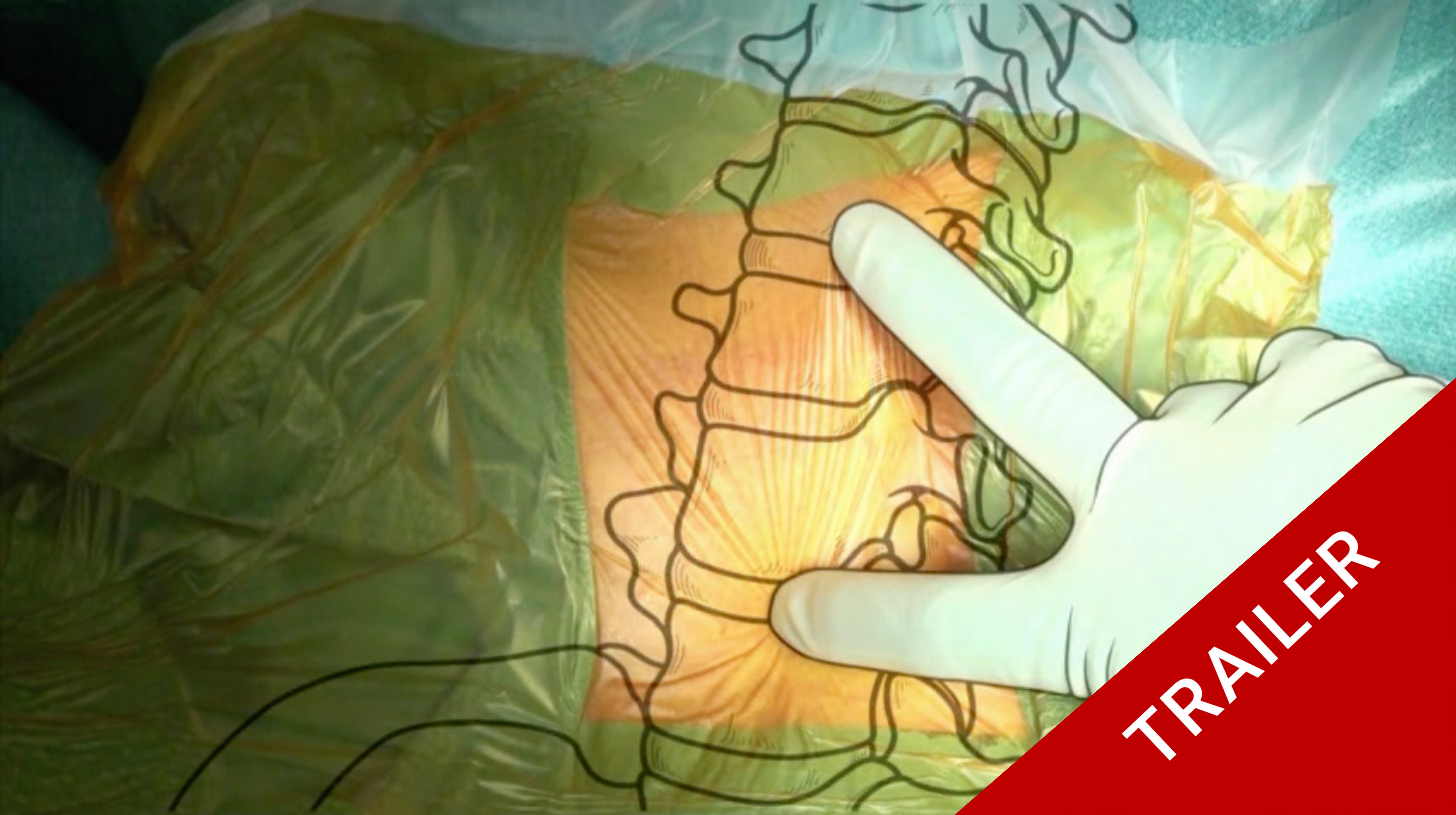 Trailer Single level anterior cervical discectomy and interbody fusion