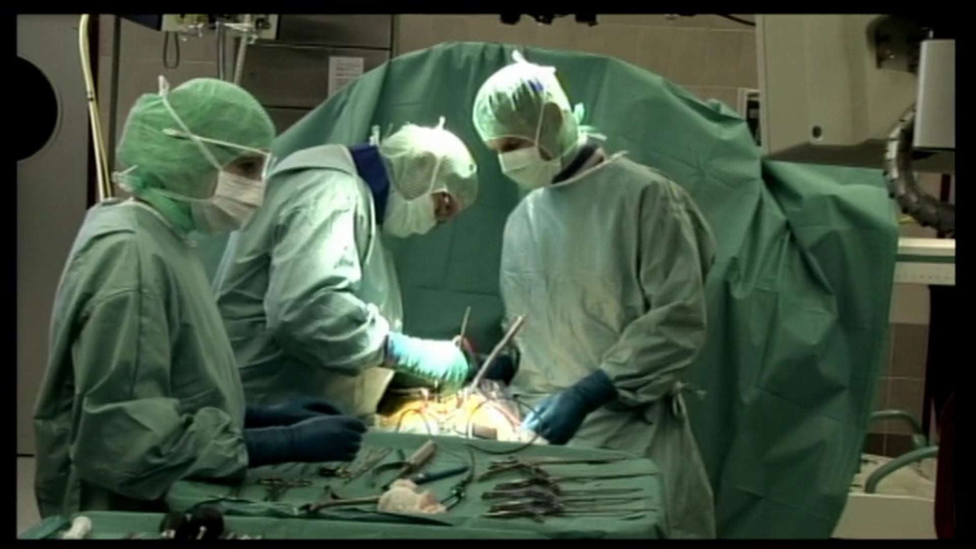 Low grade lytic spondylolisthesis L4-L5 treated with PLIF