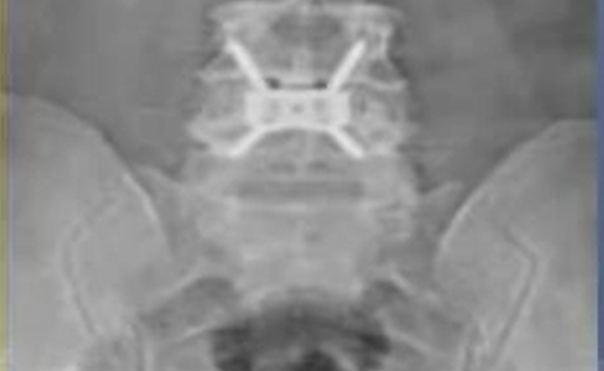 Minimal invasive anterior lumbar interbody fusion - Mini ALIF