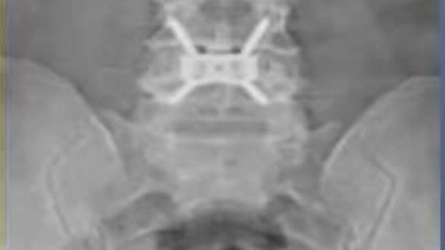Minimal invasive anterior lumbar interbody fusion - Mini ALIF