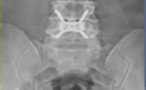 Minimal invasive anterior lumbar inte...