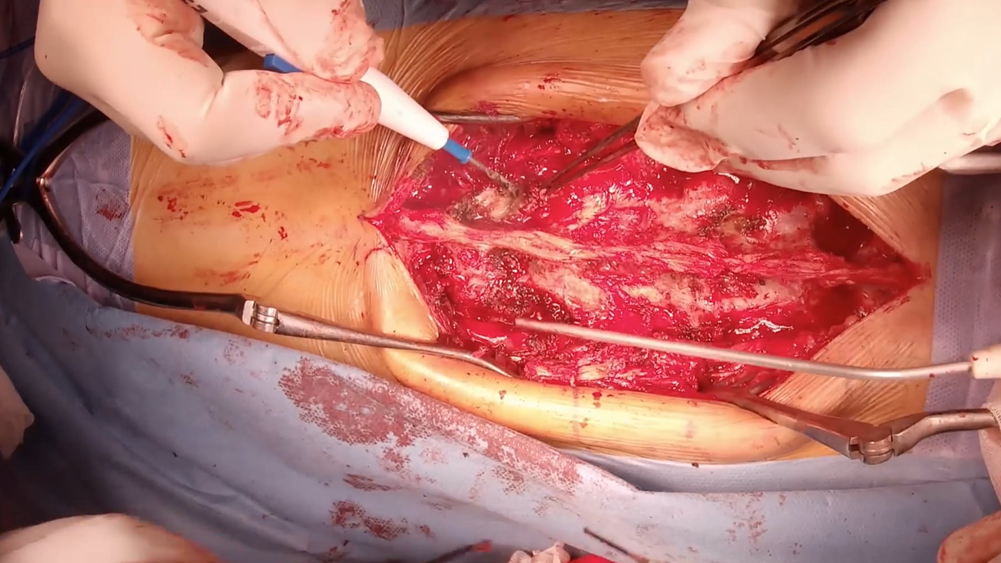 PSO in Ankylosing Spondylitis of the throacolumbar spine