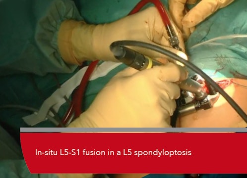 Teaser In-situ L5-S1 fusion in a L5 spondyloptosis
