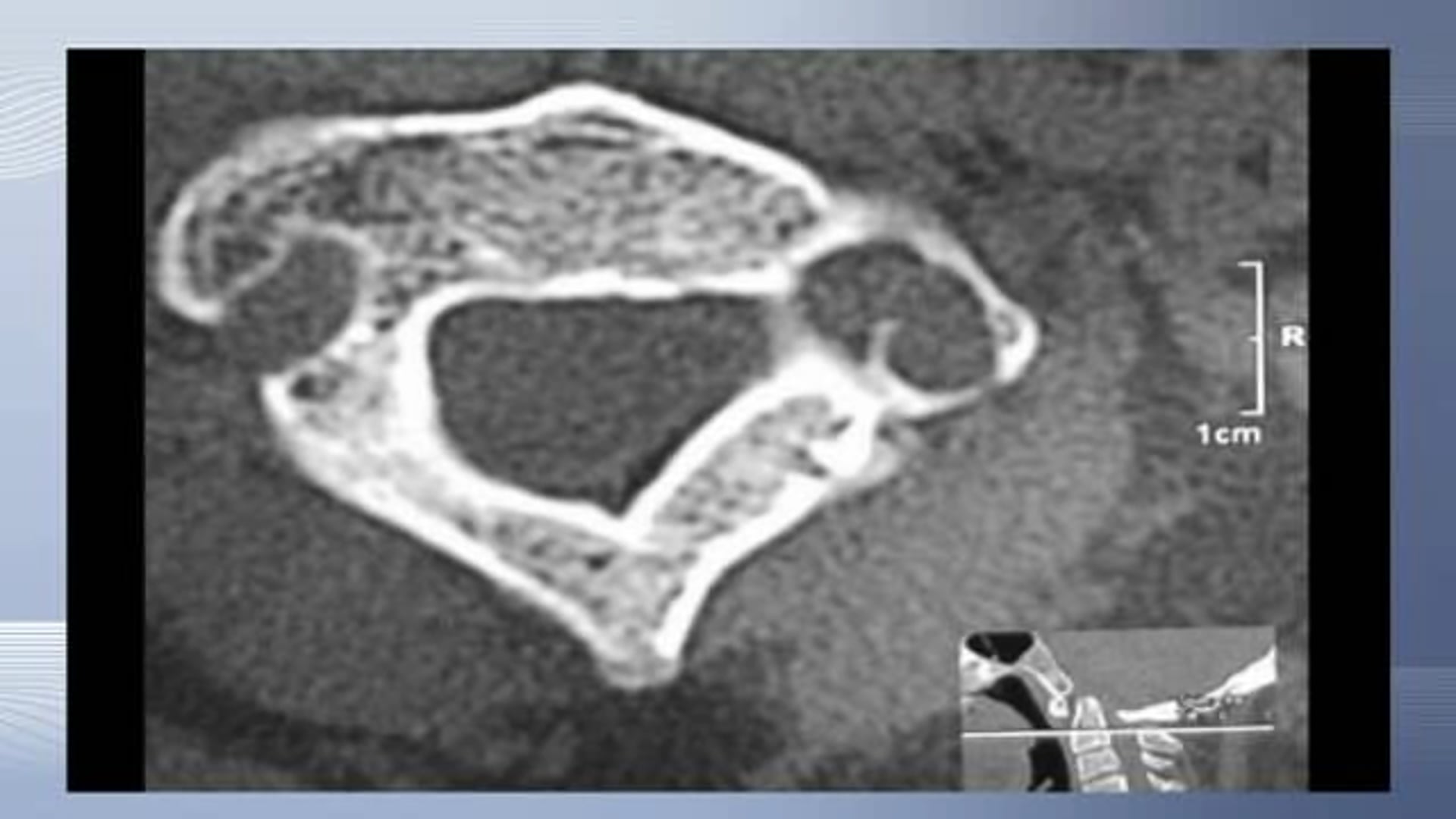 Occipitocervical fusion