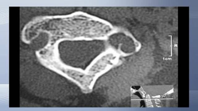 Occipitocervical fusion