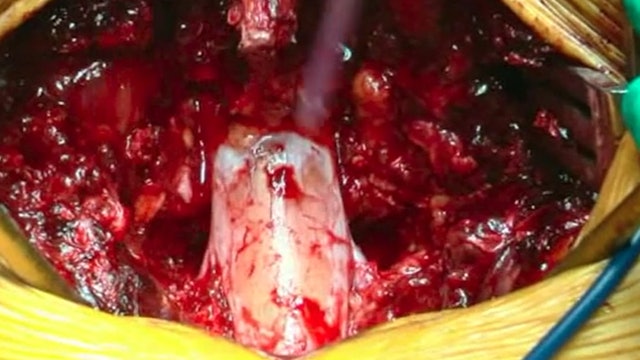 Bleeding control in pedicle subtraction osteotomy