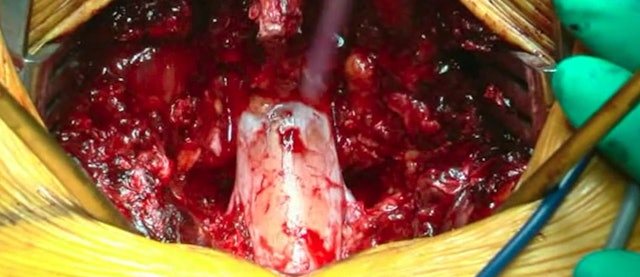 Bleeding control in pedicle subtraction osteotomy