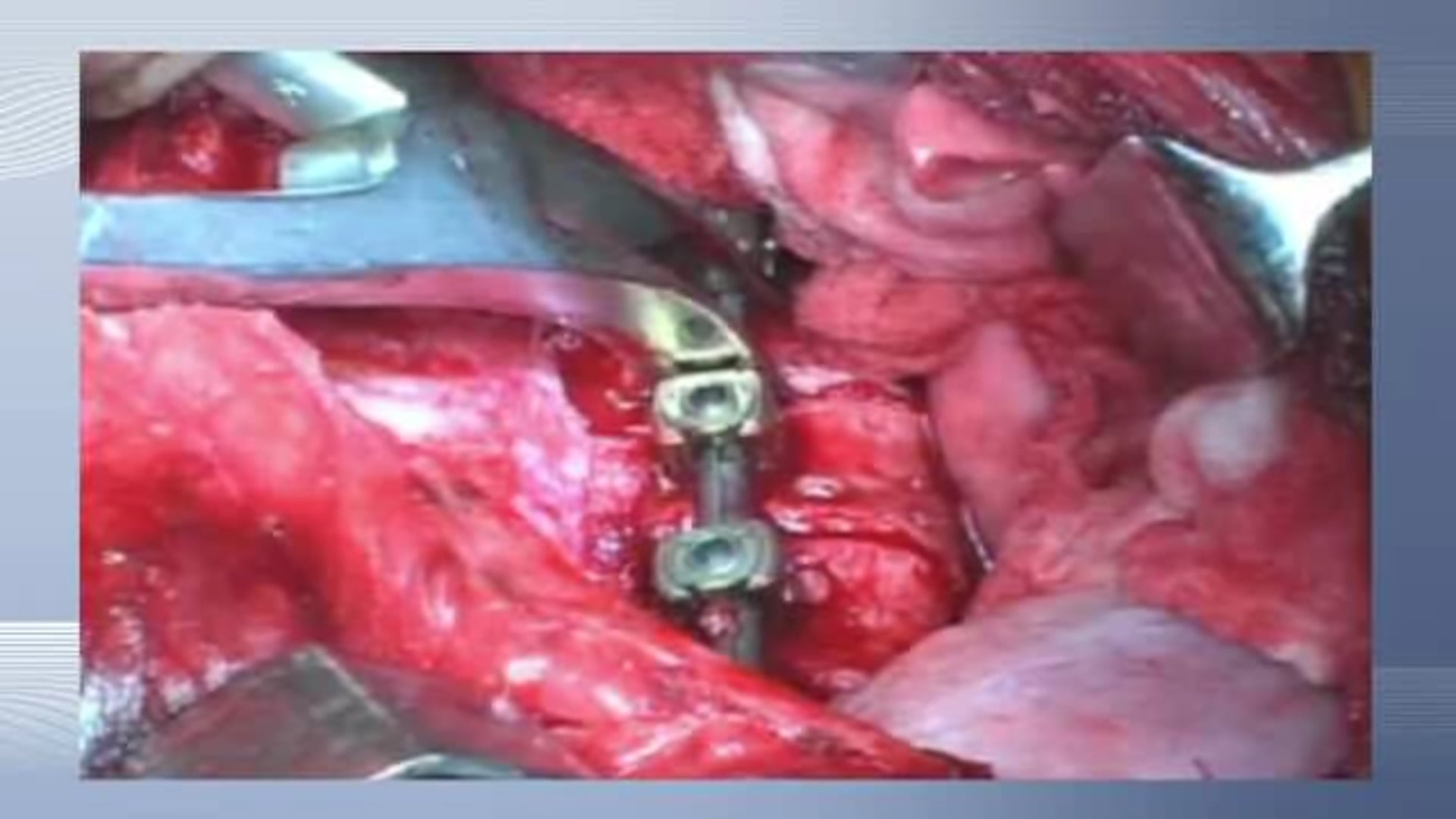 Anterior fusion for thoracic scoliosis