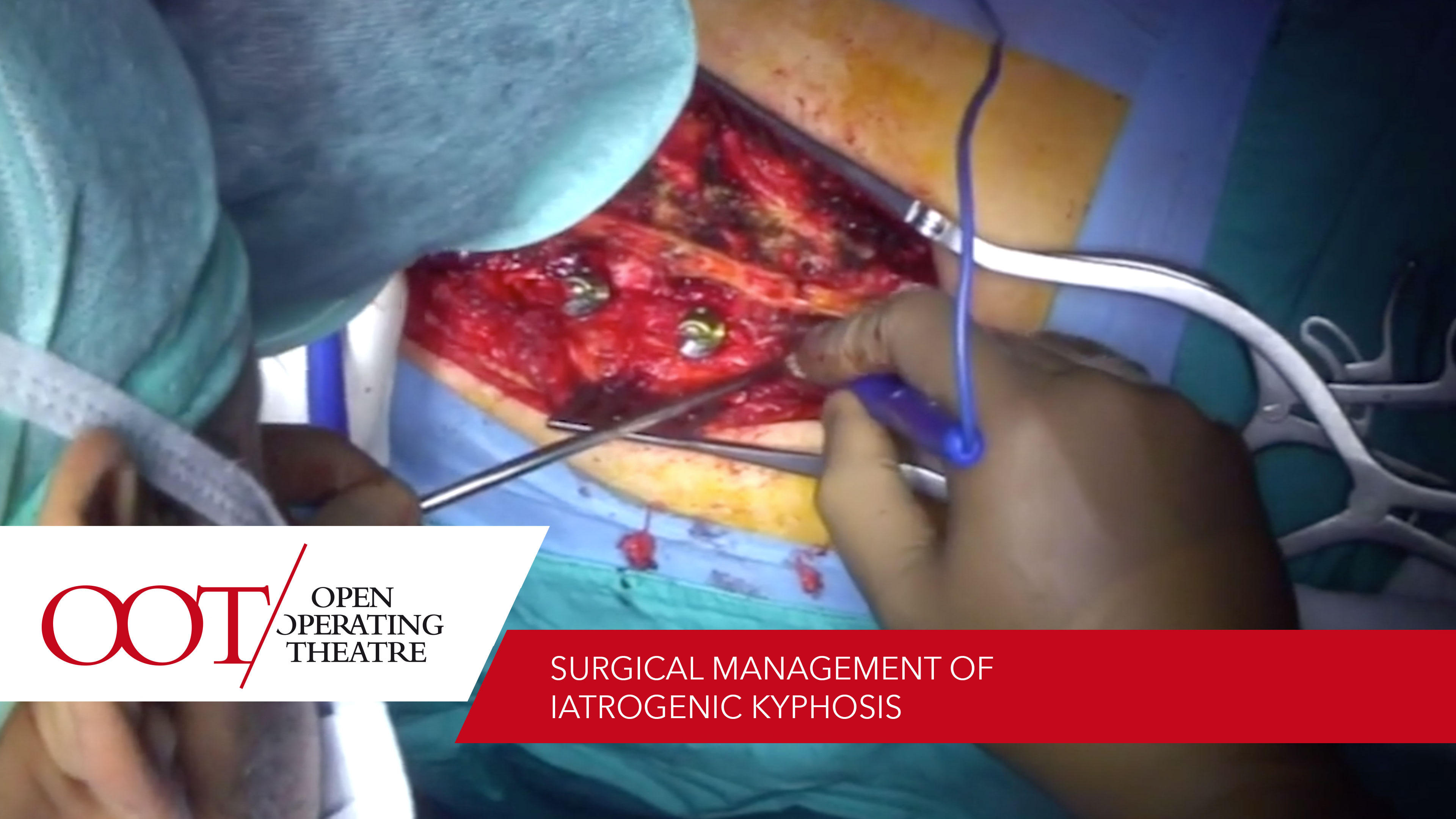 Surgical management of iatrogenic kyphosis 