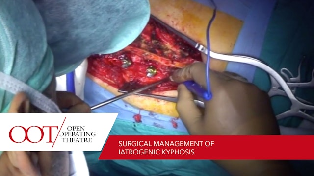 Surgical management of iatrogenic kyphosis 