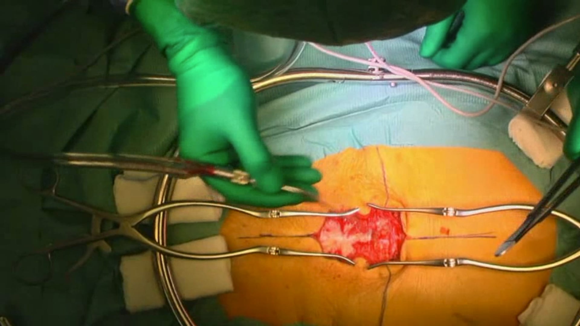 Trailer Revision and stabilization surgery of an adult degenerative scoliosis