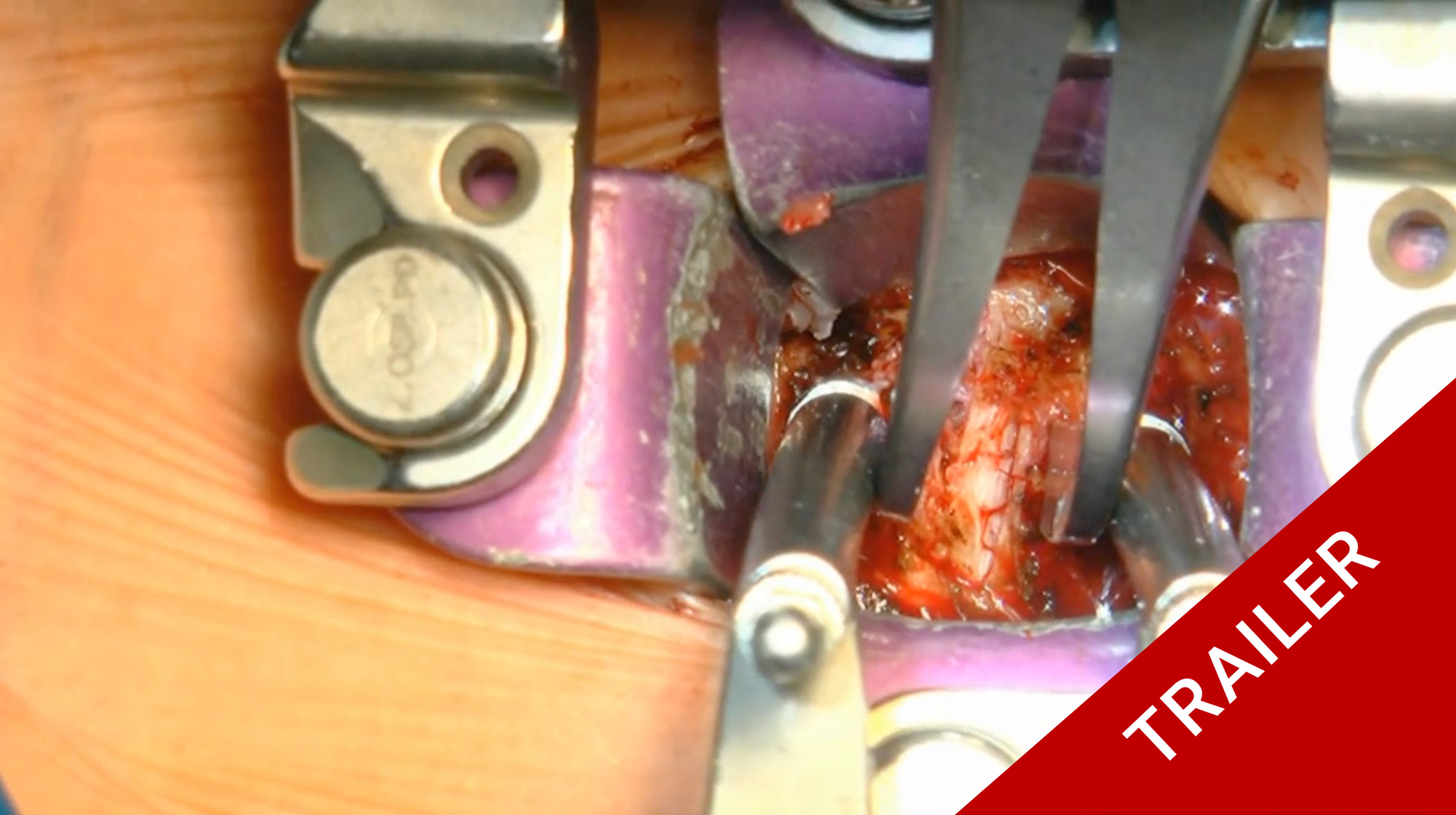 Trailer ACDF and posterior lateral masses screws for post traumatic.....