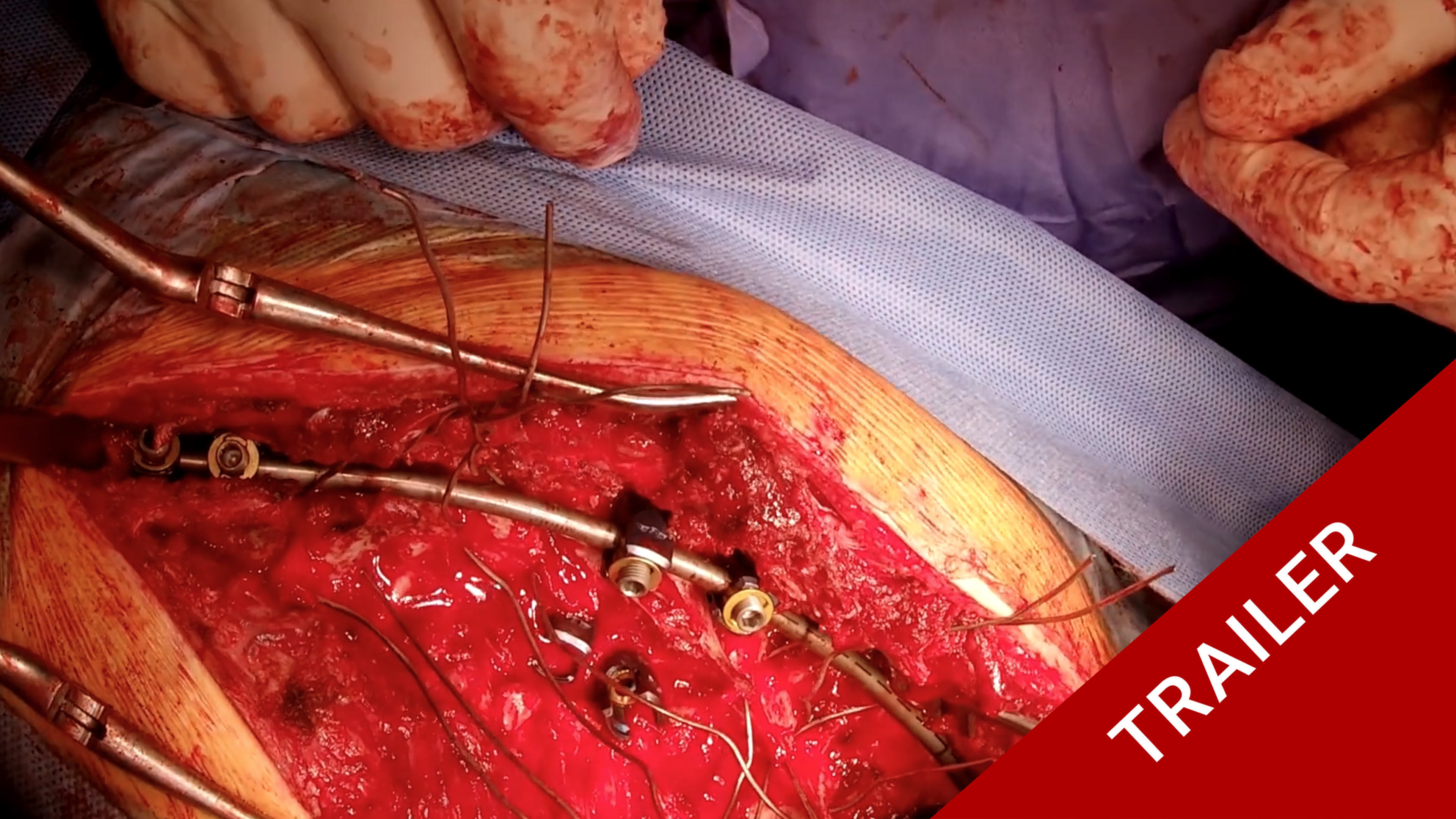 Trailer Severe Deformity in Osteogenesis Imperfecta (Briddle Bone Disease)