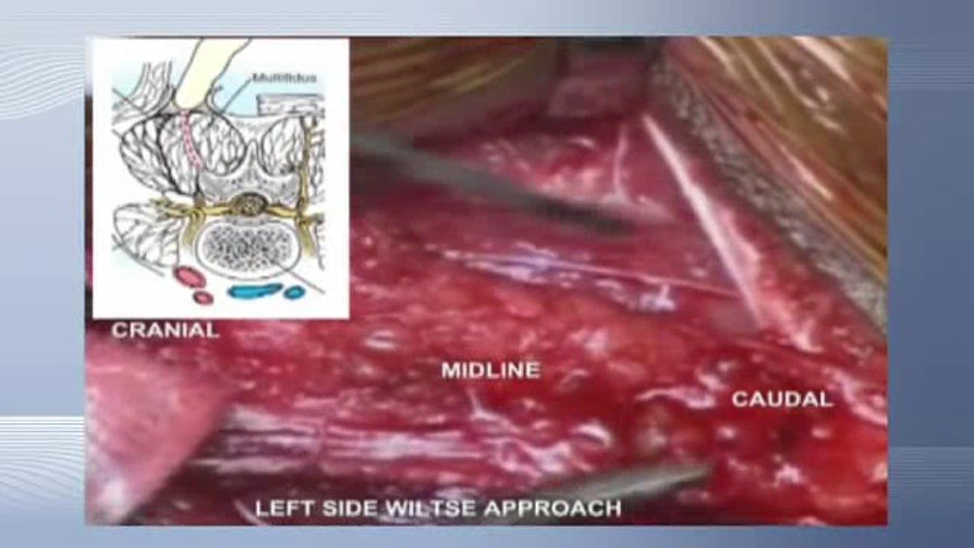 Dual growth rods for infantile scoliosis