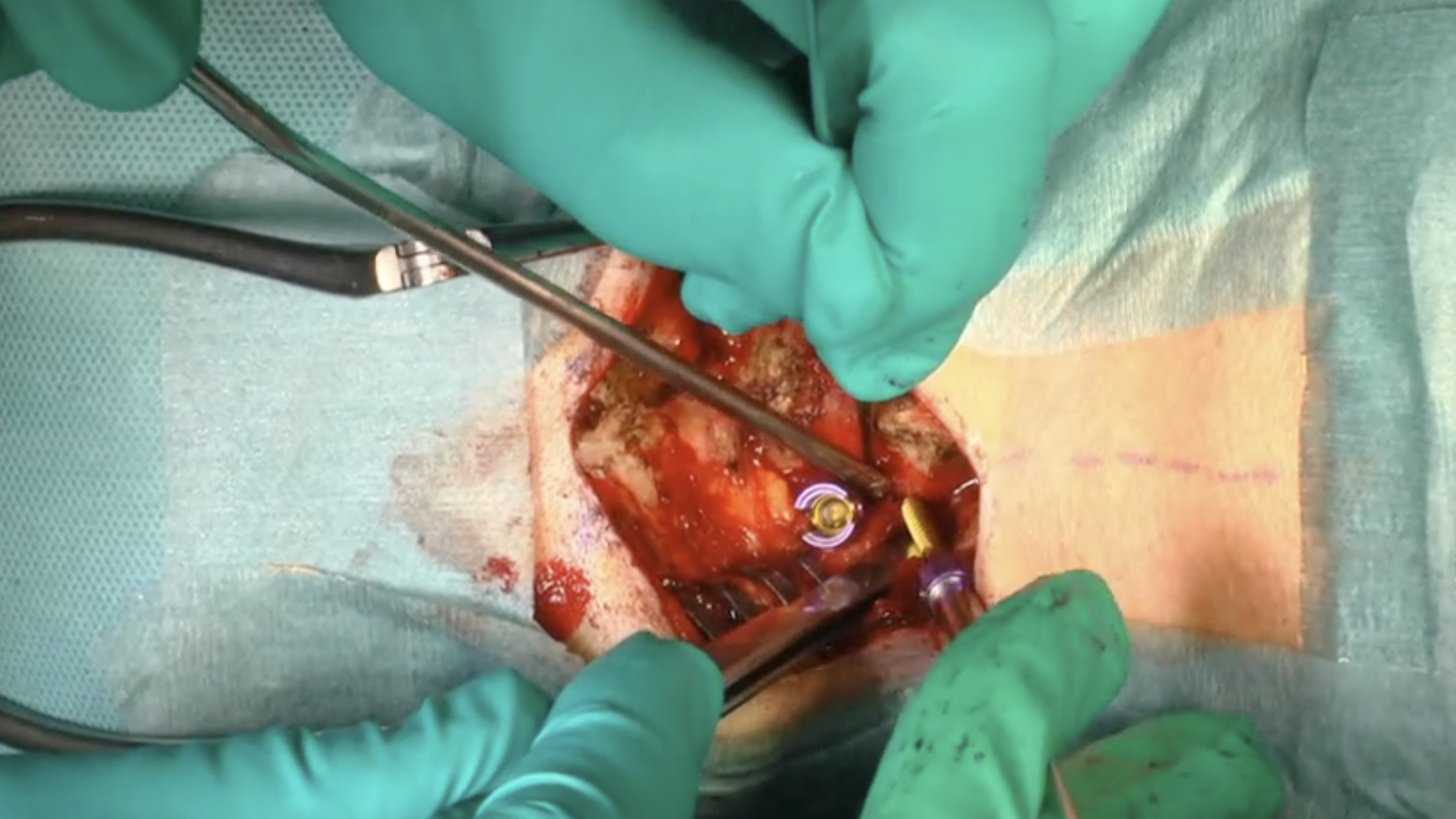 Trailer Atypical C2 fracture treated by posterior atlantoaxial fusion .....