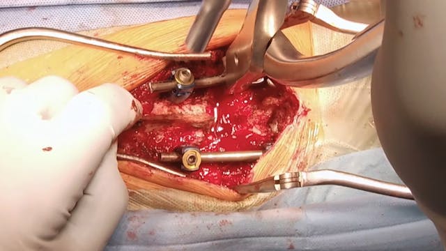Congenital Thoracolumbar Kyphoscoliosis