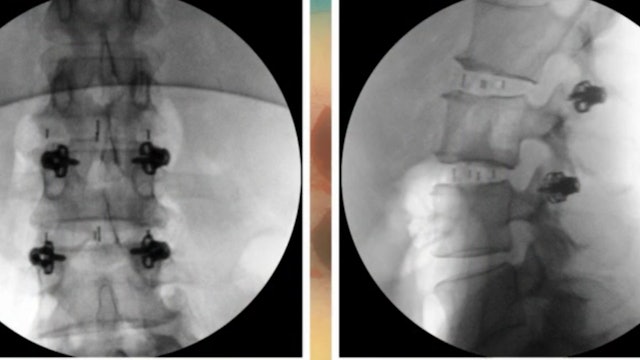 Minimally invasive posterior segmental instrumentation and fusion with.........