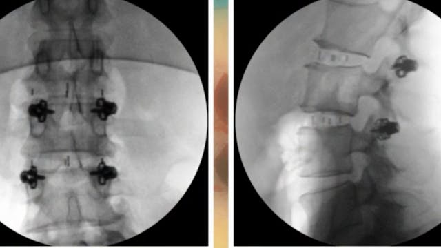 Minimally invasive posterior segmenta...