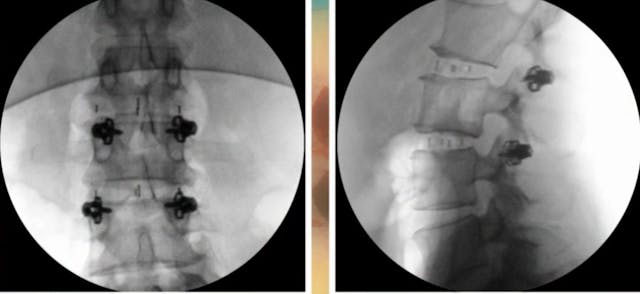 Minimally invasive posterior segmenta...