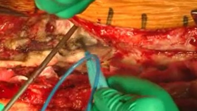 Trailer Pedicle subtraction osteotomy for postoperative flat back and ....