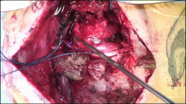 Posterior resection of a cervical spi...