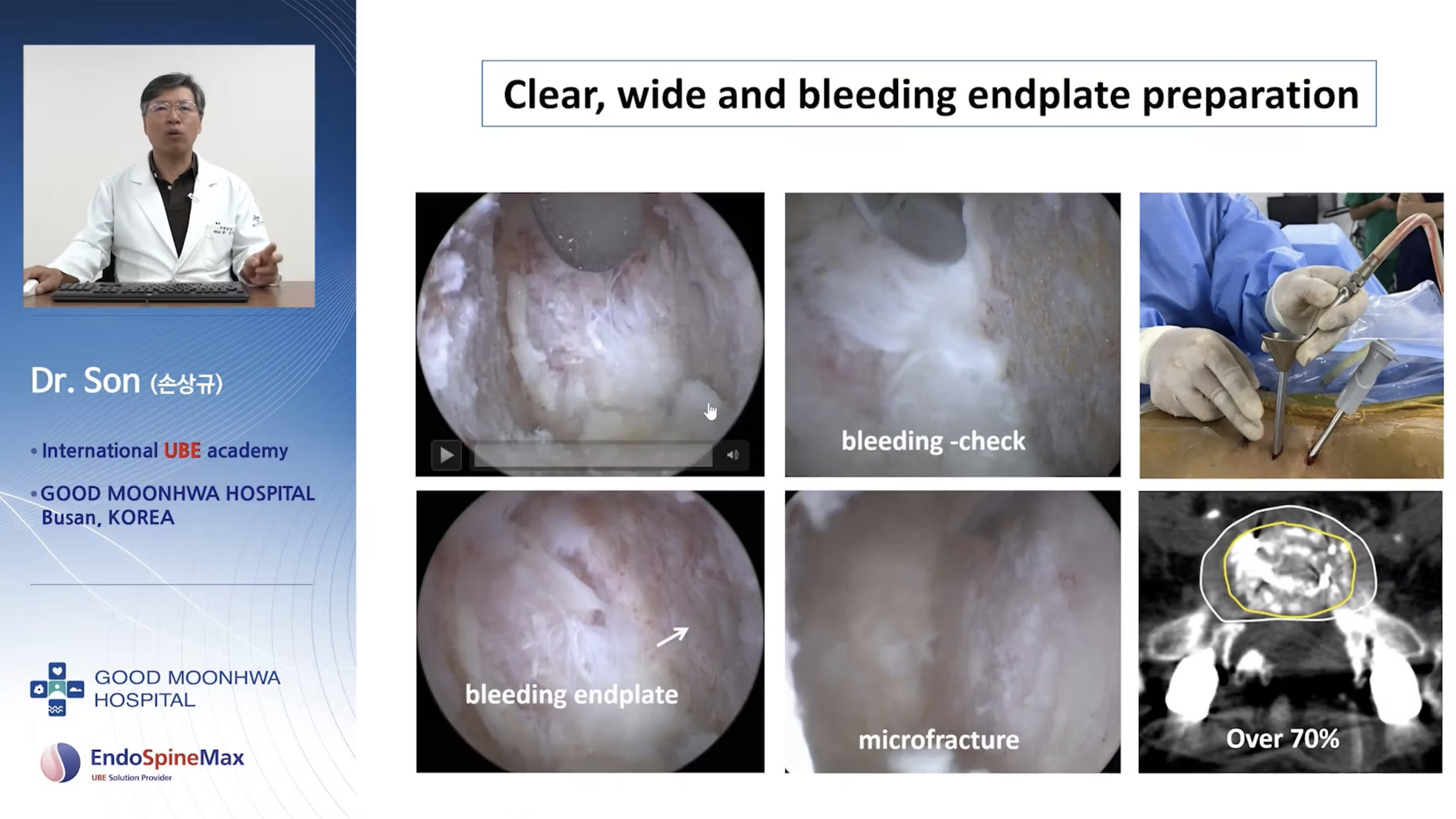 UBE lumbar interbody fusion, ULIF