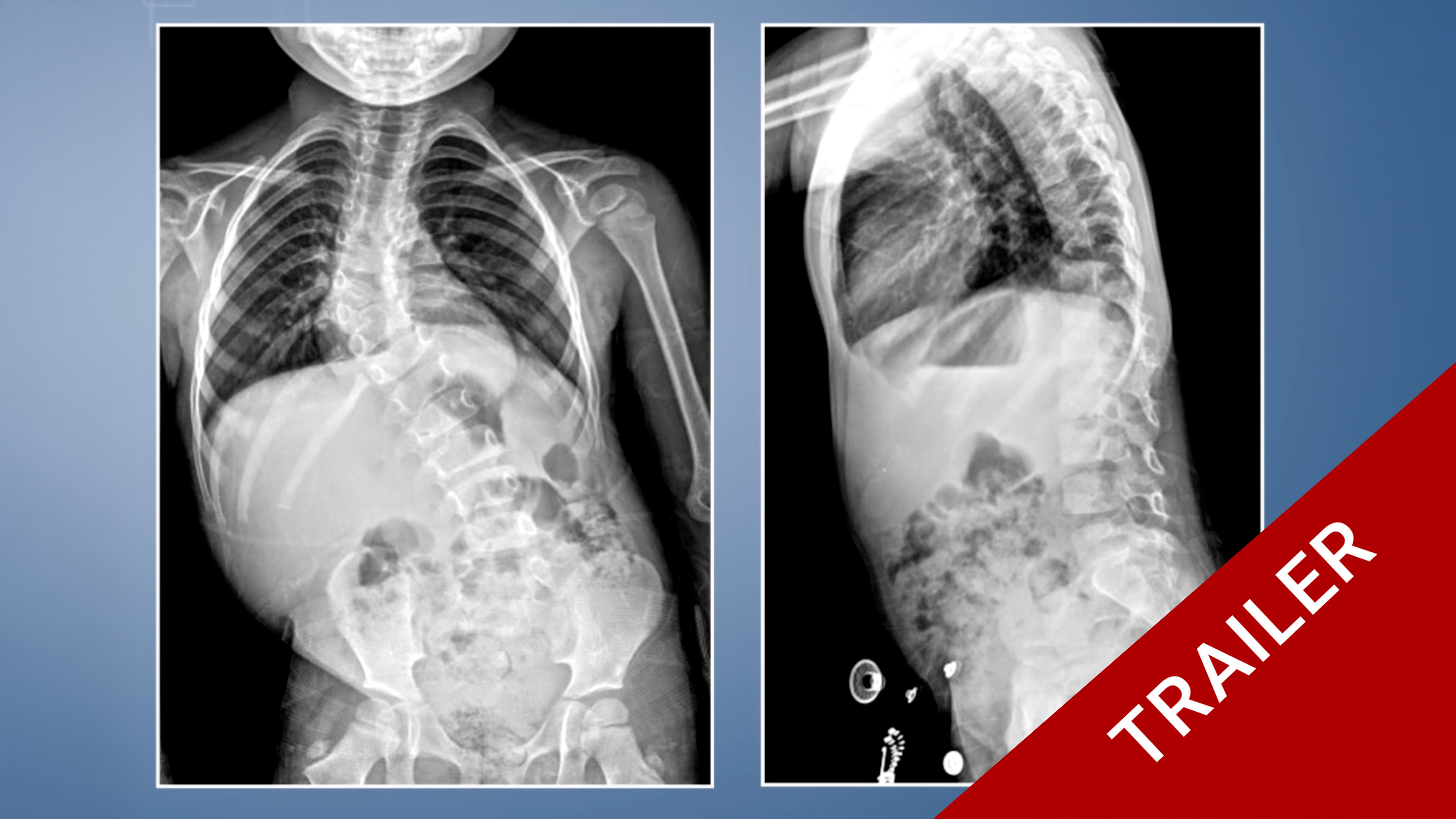 Trailer Resection of Thoracic Hemivertebra in Congenital Scoliosis