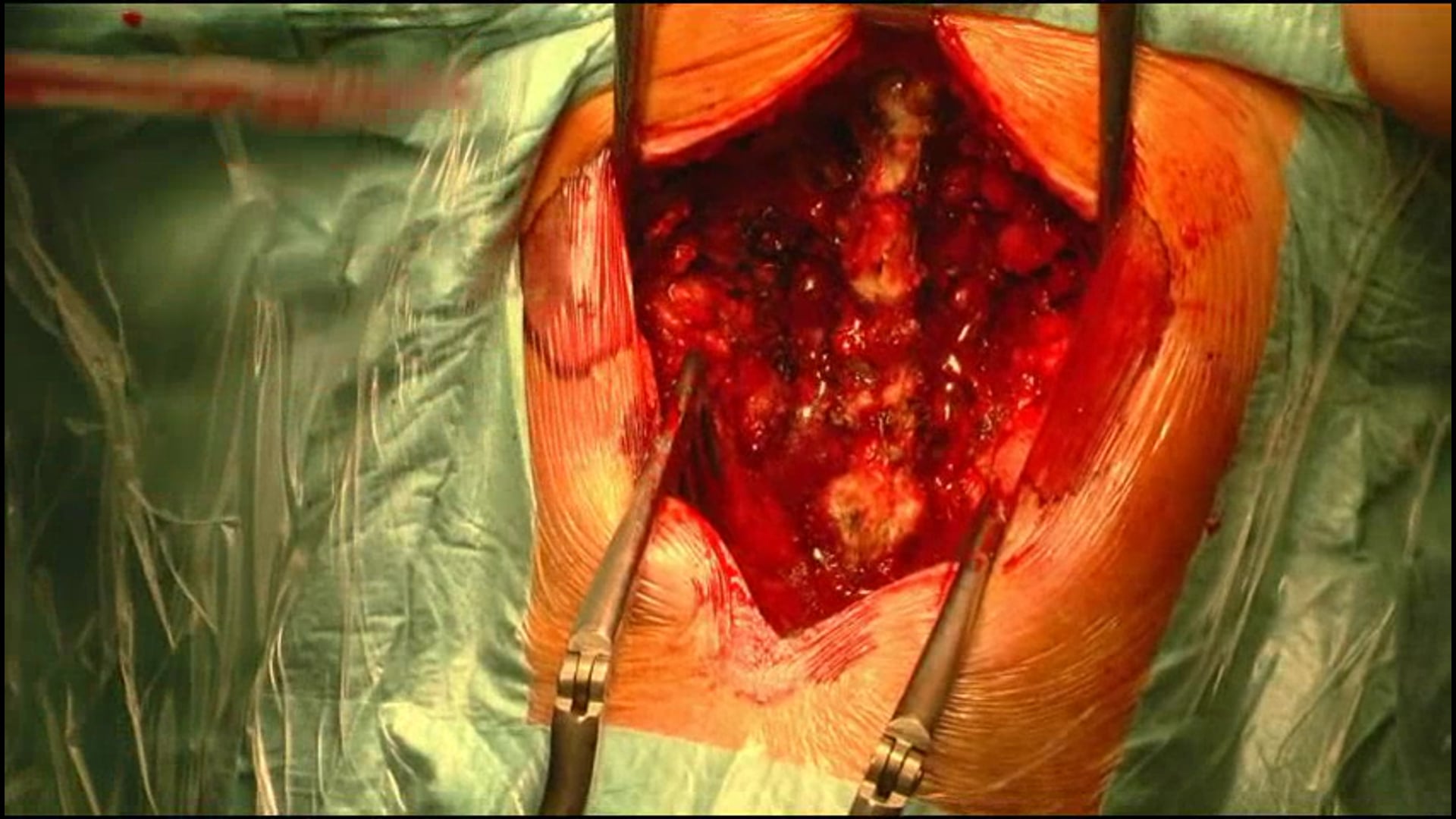 Circumferential convex growth arrest by posterior approach .......