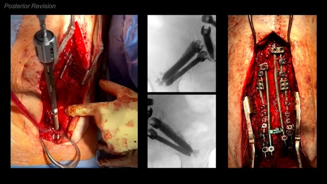 Trailer Surgery for distal junctional failure with pelvic pull-out and ALIF cage