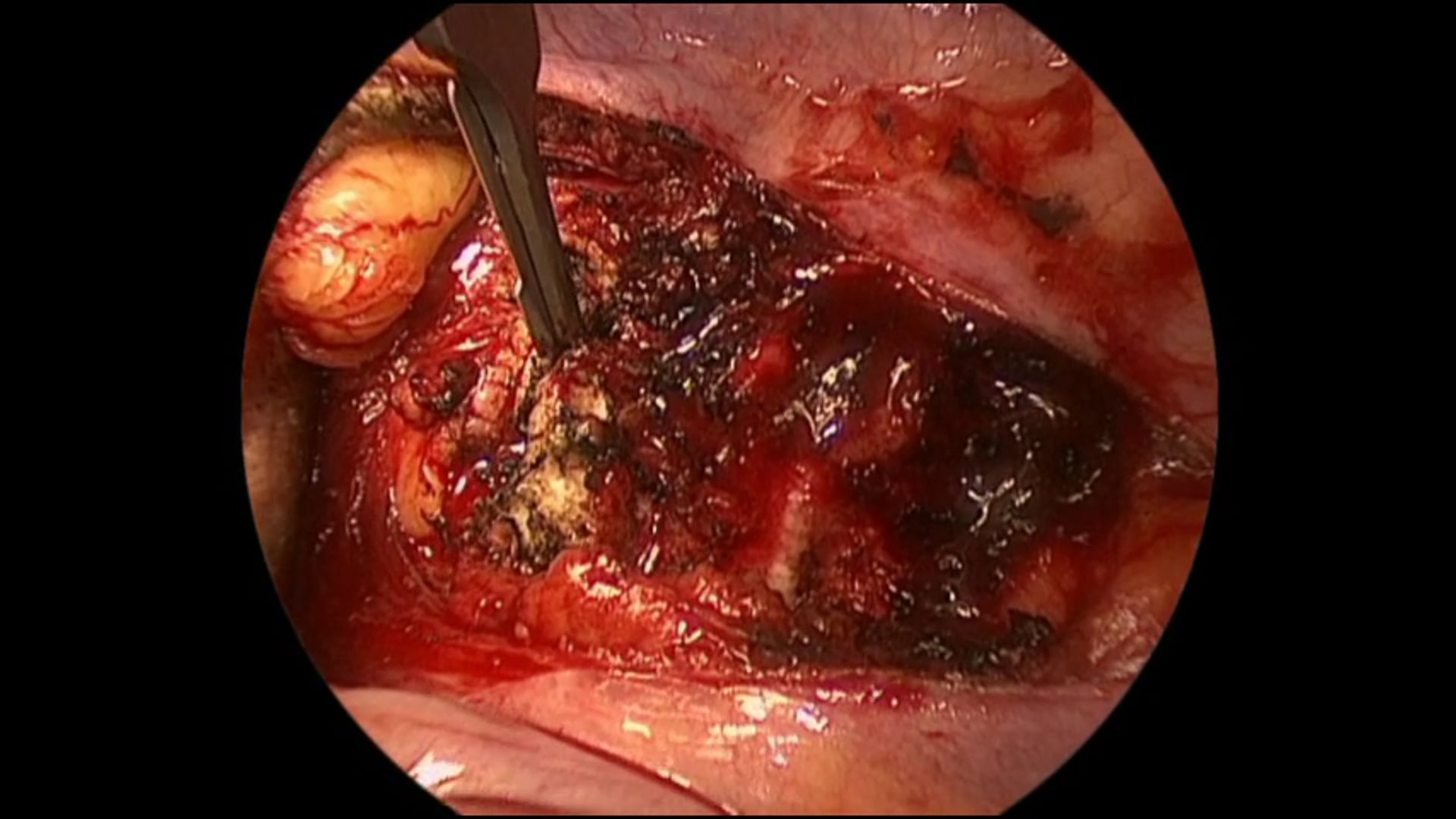 Anterior osteotomy and percutaneous in situ contouring ..