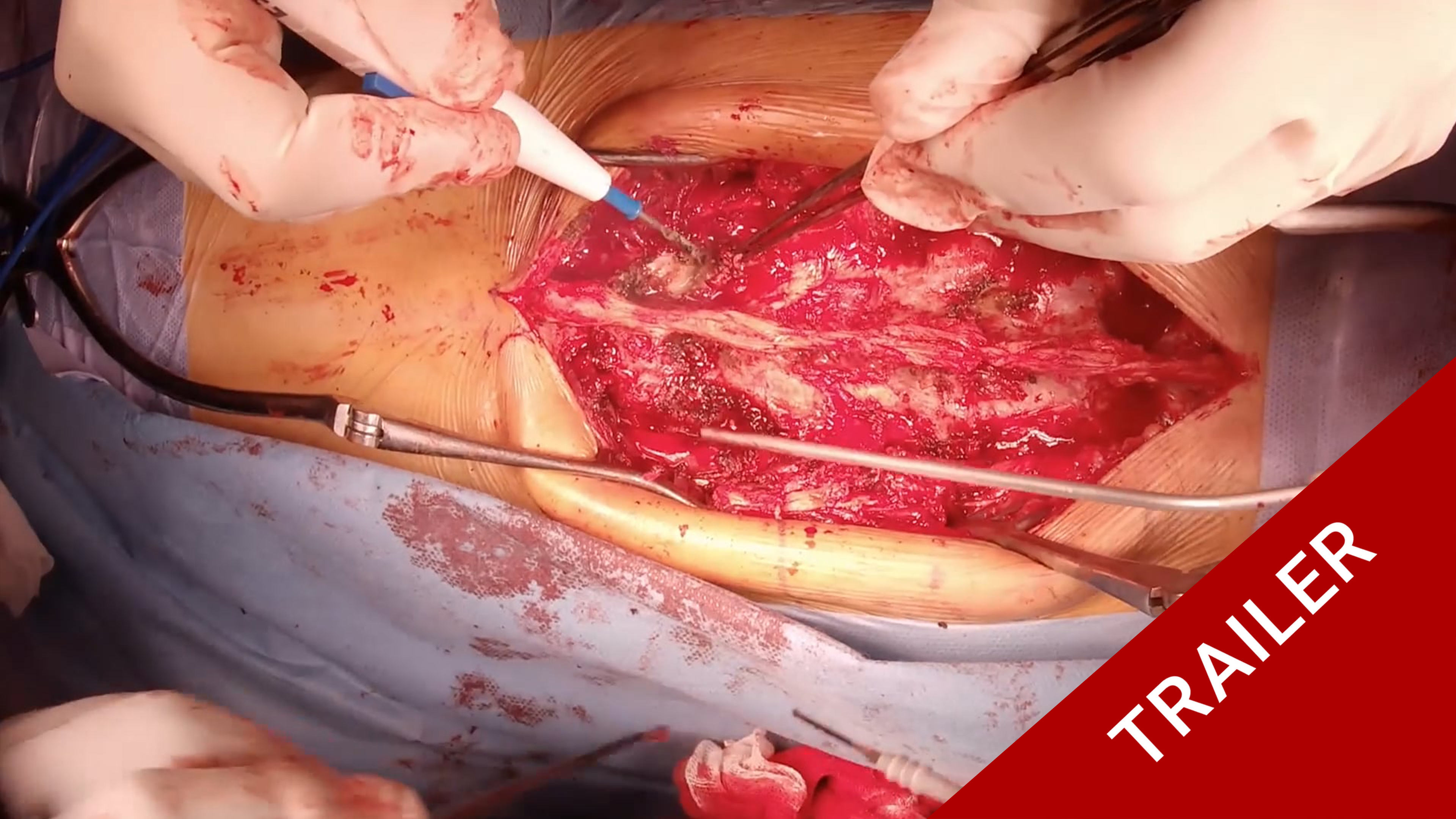 Trailer PSO in Ankylosing Spondylitis of the throacolumbar spine